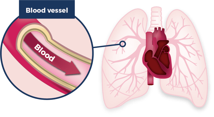Lungs and pulmonary artery image
